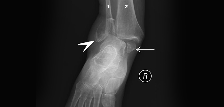 Ankle Fracture Fixation Patients: Good News