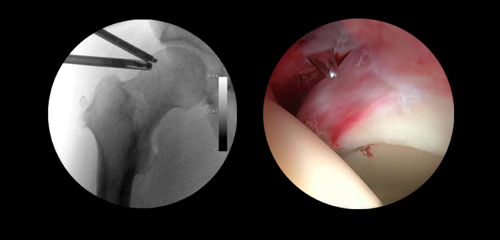 Updating Capsular Management in Hip Arthroscopy; Osteonecrosis Genetic Mutation Found; Mercy Health Wins AOSSM Systematic Review Award