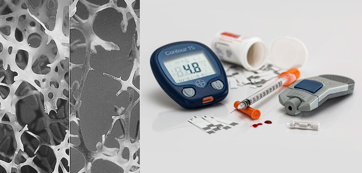 New Drug Treats Bone Loss AND Diabetes