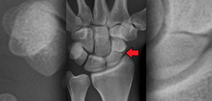 New Study: 1 out of 6 Scaphoid Fractures Are Nonunion