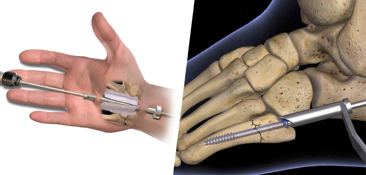 Stryker Acquires Instratek Extremity Products