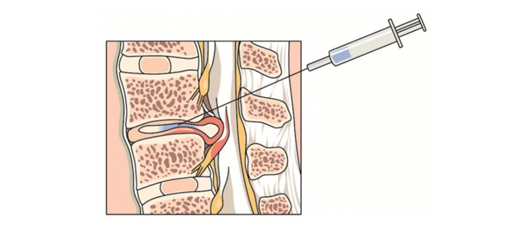 Will a $95 Million Deal Bring Chemonucleolysis Back?