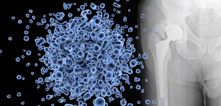 Two-Stage Exchange Arthroplasty and Positive Cultures