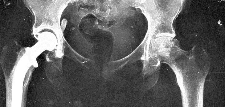 Readmission Rates Post Joint Replacement: Adjust for Race, SES?