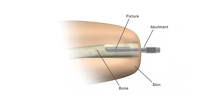 First Osteointegrated Surgery Performed in California