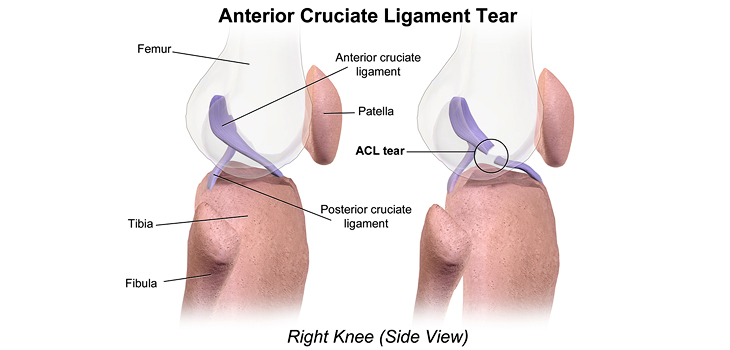 Non-Contact ACL Injuries: Prevention Needed!
