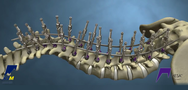 K2M’s MESA Cleared for Kids With Spinal Deformities