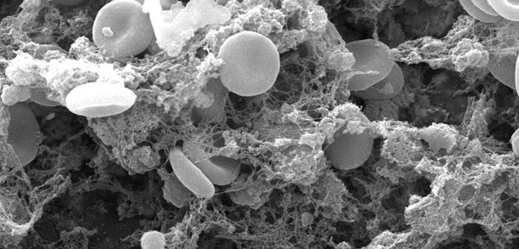 Positive Results for Blood Clot Medication XARELTO