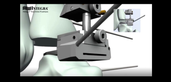 First European Implants of Integra’s New Cadence Ankle System