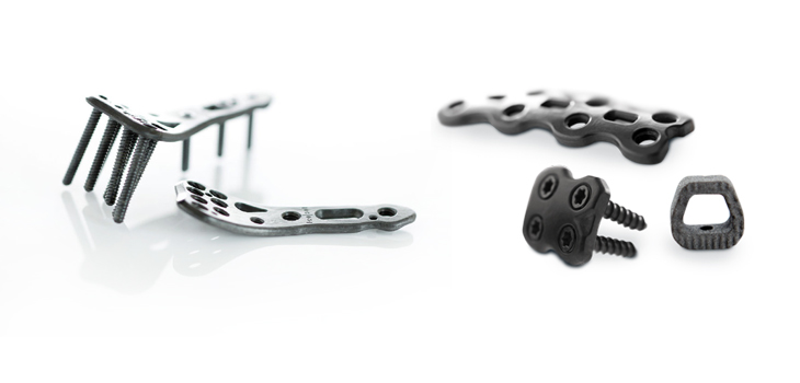Carbon Reinforced PEEK vs Metal Implants
