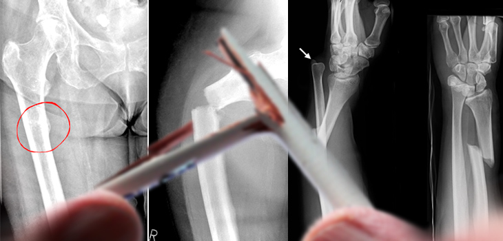 Types 1 and 2 Diabetes: Elevated Fracture Risk