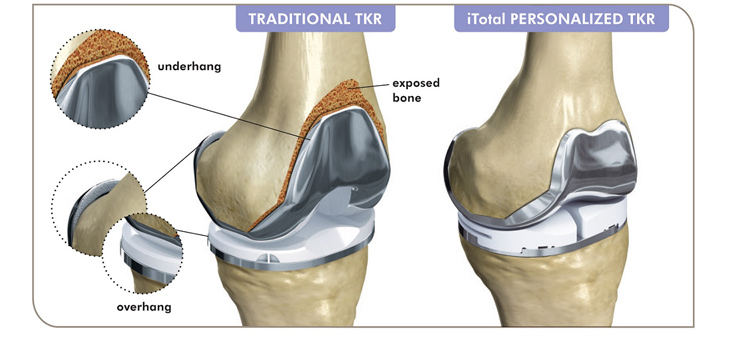 ConforMIS iTotal CR Outperformed Off-the-Shelf Implants