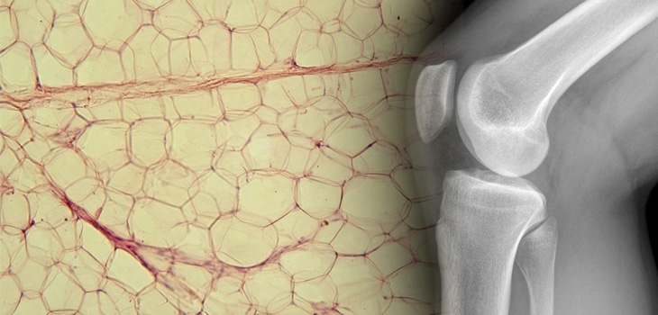 Watching Fat Cells Become Bone Cells: New Osteoporosis Info!