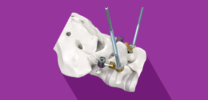 Amendia Launches Syzygy Spinal Stabilization System