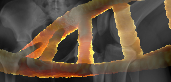 Genetics Predict Osteoporotic Fractures!