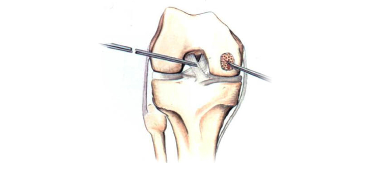 Autologous Chondrocyte Implantation and Microfracture: No Difference