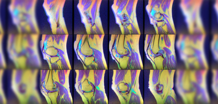 Here’s How Rare Meniscus Cartilage Repair Is