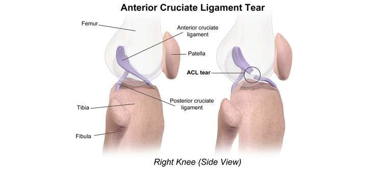 How OA Can Follow ACL Injury