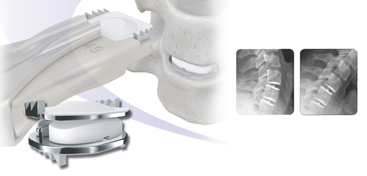 Mobi-C Becomes Most Widely Covered Cervical Disc