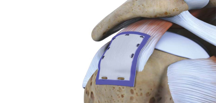 Rotation Medical’s Bioinductive Implant: Positive Results