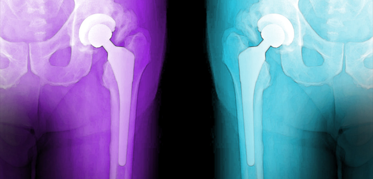 Hip Replacement Patients NOT Moving More?