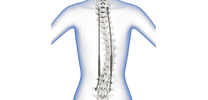 NuVasive: 510(k) Clearance for MAGEC