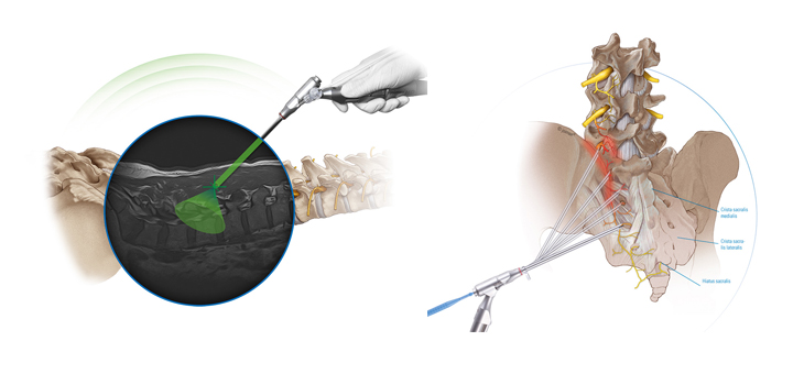 New Endoscopic Tools From joimax at Eurospine 2016
