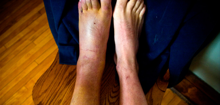 Avoid Ankle Surgery With New Casting Technique!