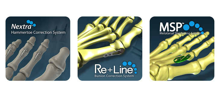Zimmer Biomet Secures Exclusive Distribution Rights for Nextremity Foot and Ankle Lines