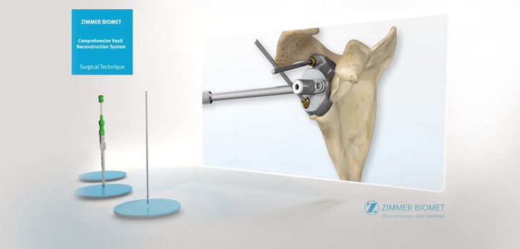 Personalized Shoulder Reconstruction Implant From Zimmer Biomet