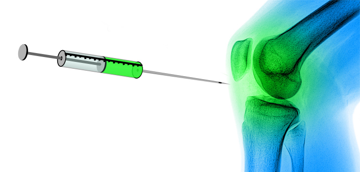 Knee OA Symptoms Improve After Prolotherapy