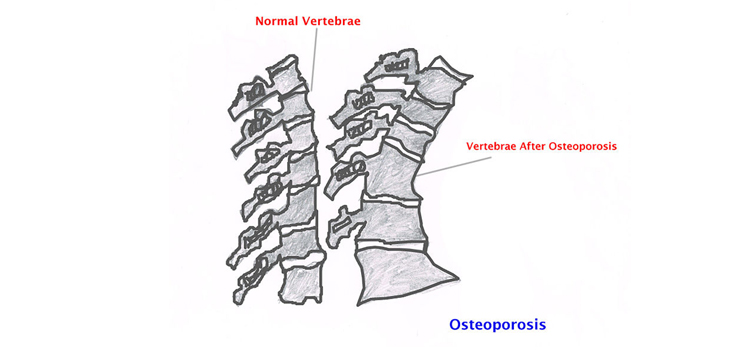 Biologics for RA Could Protect Against Rapid Bone Loss