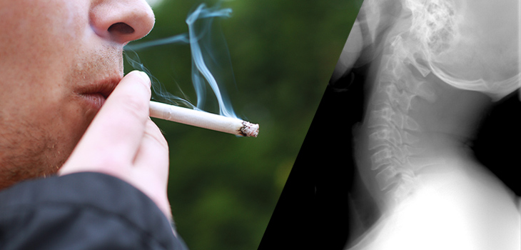 Lifetime Cigarette Use Affects Spine Healing