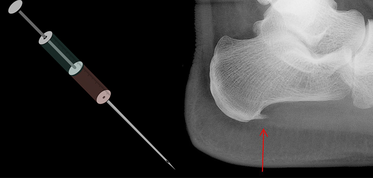 Revance: Botulinum Toxin for Plantar Fasciitis