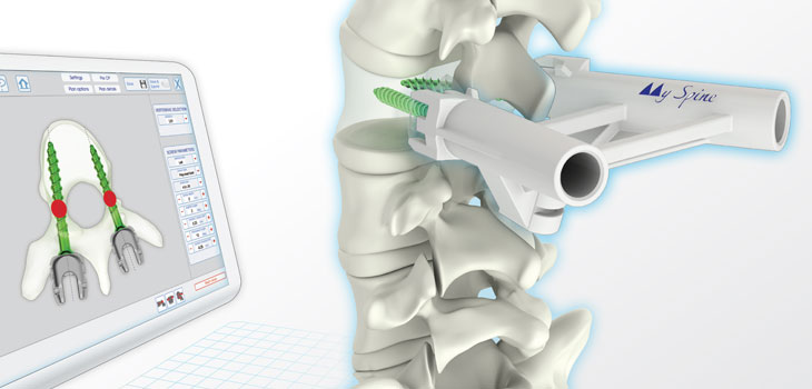 Medacta: First U.S. Surgeries With MySpine