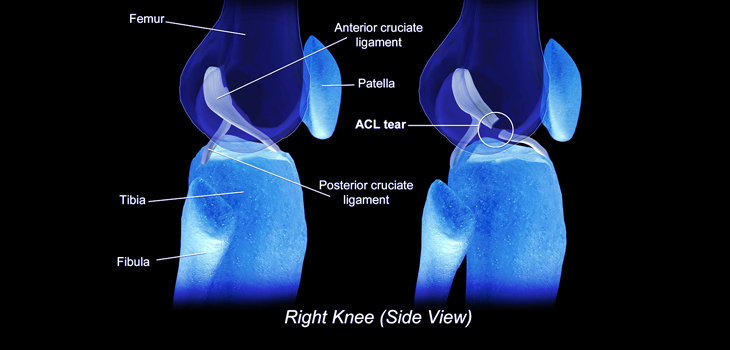 1 in 3 Undergoing ACL Surgery Before 20 Will Reinjure!