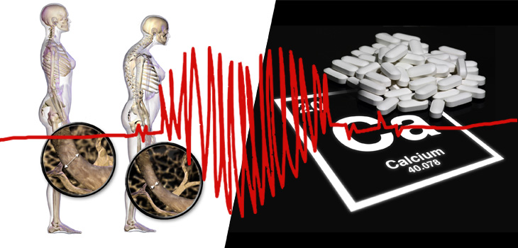 Osteoporosis, Cardiology Organizations Issue Calcium Guideline