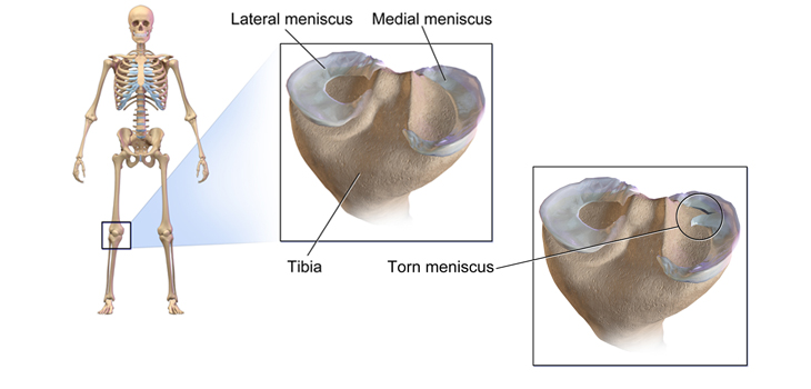 Recognize, Treat Meniscal Root Tears!