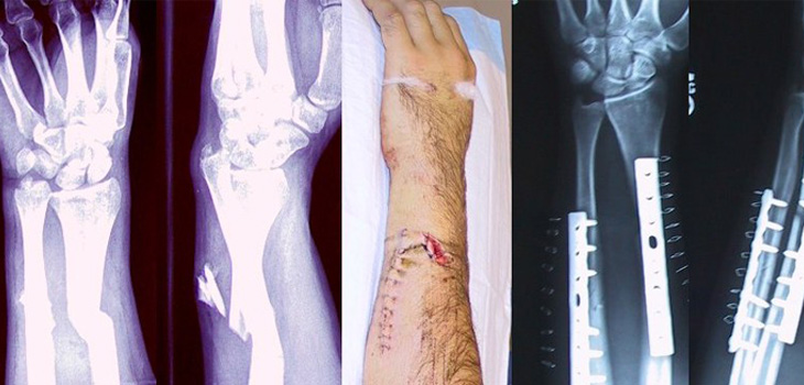 Fracture Liaison Services Showcased at IOF Regionals
