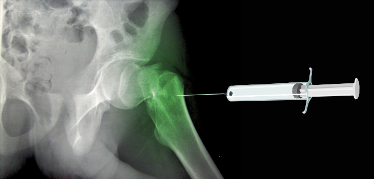Established Drug Can Get You Going Faster Post-Hip Fracture