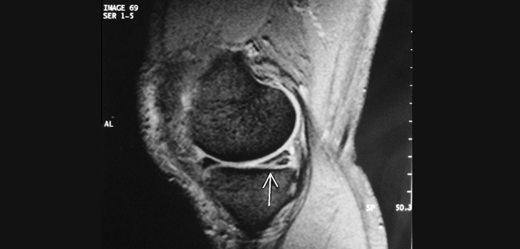 ‘Living Bandage’ for Meniscal Tears: Human Trial