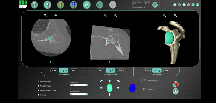 Patient-Specific Planning for Shoulder Replacement