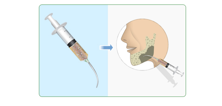 Bone Graft Slurry Hardens into Bone in Israeli Trial