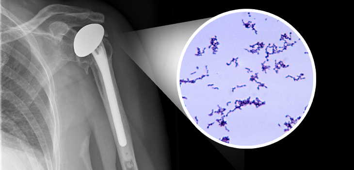 Neer Award: Rapidly Detect Propionibacterium acnes in Shoulder