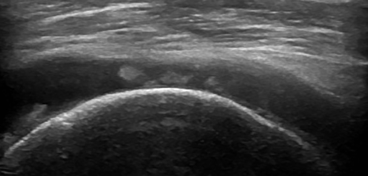Shoulder Stiffness=Healing in RC Repair?