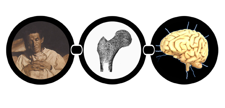 Alzheimer’s Bone, Brain Link!; Significant Increase in Bone Formation; Cost of Preoperative Interventions