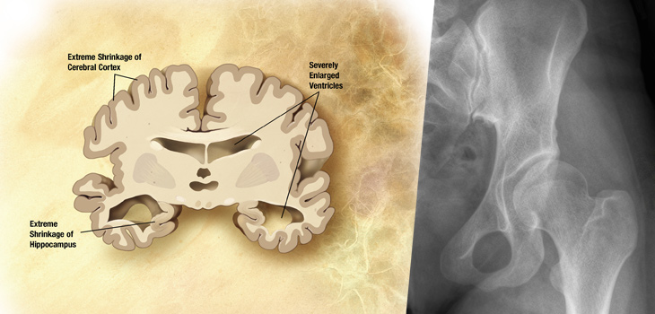 Benzodiazepines: 43% Hip Fracture Increase in Alzheimer’s Patients