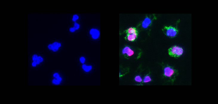 Gum Bacterium Triggers RA Response