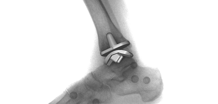 New Coding System for Reoperation in Ankle Surgery