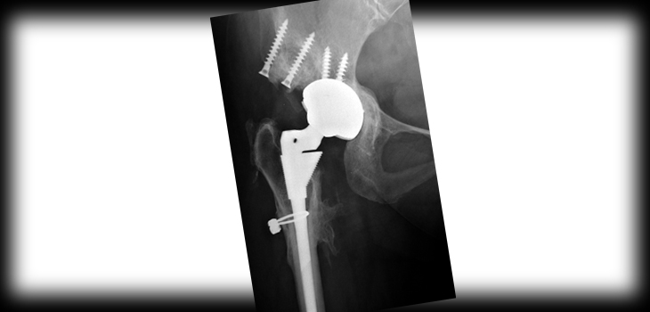Cost-Sharing in TJA: Perhaps Let the Patient Decide